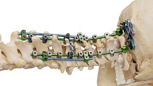 Occipito-cervico-thoracic osteosynthesis unit Invictus® OCTposterioradult