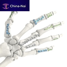 Hand phalange compression plate metacarpal jointlockingtitanium