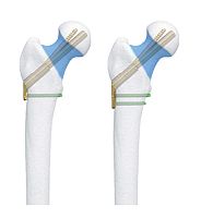 Femoral head compression plate