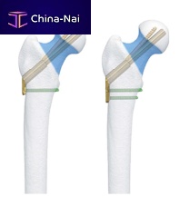 Femoral head compression plate
