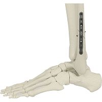 Fibula osteotomy plate PK-SFP seriesmid-shaftnon-lockingmetallic
