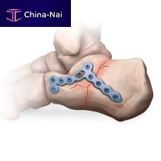 Calcaneus compression plate