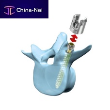 Lumbar pedicle screw �mediRod®�-Tripolyaxialcannulated