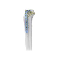 Tibia compression plate proximallaterallocking