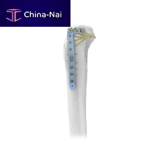 Tibia compression plate proximallaterallocking
