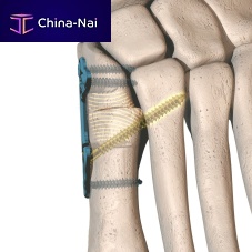 Hallux valgus osteotomy plate dynaBunion®