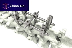 Thoraco-lumbar pedicle screw M9-Iapolyaxialmonoaxialtitanium