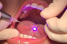 Surgical laser optical fiber Disposable Tips