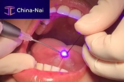 Surgical laser optical fiber Disposable Tips