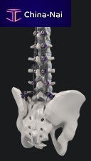 Thoraco-lumbar osteosynthesis unit SYNSTER® DOMINOposterioradult