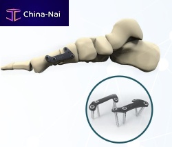 Hallux valgus arthrodesis plate FRC200 serieslockingmetallic