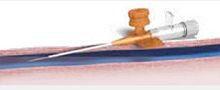Medical laser optical fiber ELVeS® Radial® Swift