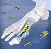 Forefoot compression plate 400120 serieslockingtitanium