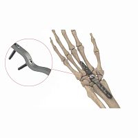 Wrist arthrodesis plate AS.W.074dorsallockingnon-locking