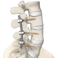 Thoraco-lumbar osteosynthesis unit DIPLOMAT® posterioradult