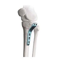 Tibia osteotomy plate proximallateral
