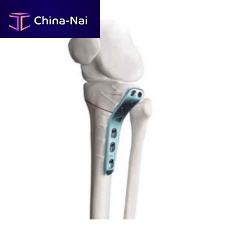 Tibia osteotomy plate proximallateral
