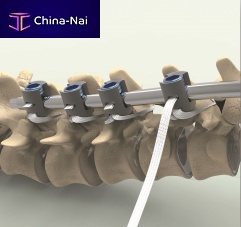 Pediatric posterior spinal fixation band Ortholox® UHMWPE