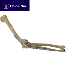 Elbow arthrodesis plate 1222-0010lockingmetallic