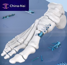 Hallux valgus osteotomy plate A-TEC metatarsophalangeal jointlockingmetallic