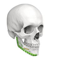 Mandible compression plate lockingmetallic
