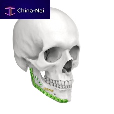 Mandible compression plate lockingmetallic
