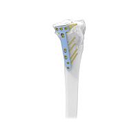Tibia osteotomy plate lockingmetallic